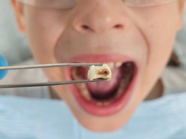 Best Emergency Dentist for Lost Fillings or Crowns in Buckeystown, MD